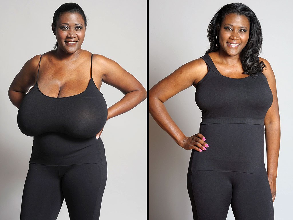 The Top Benefits of a Breast Reduction